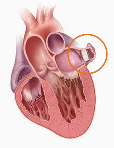 Watchmanによる治療が施された心臓の断面図